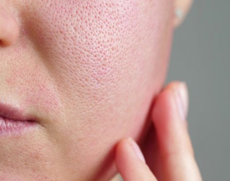 Da mặt khô nên dùng gì? Cách trị da mặt khô sần, khô rát đỏ, bong tróc
